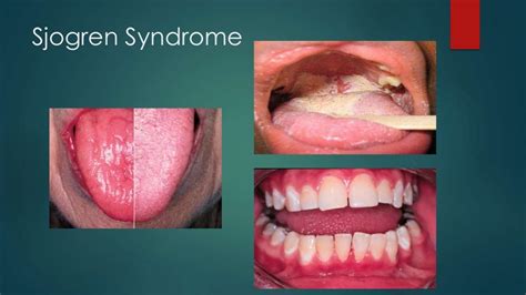 Oral Manifestations Of Systemic Diseases