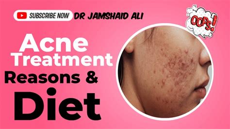 Best Homeopathy Treatment Of Acne And Pimples Chehre Ke Dane Khatam