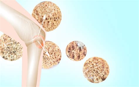 Kalsitonin Nedir? - Probiyotix