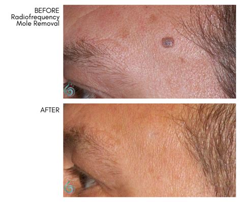 Mole Removal Pickerington OH, Bella Cosmedica