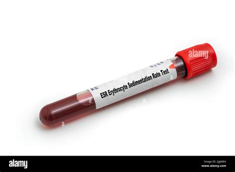 Esr Erythrocyte Sedimentation Rate Test Medical Check Up Test Tube With