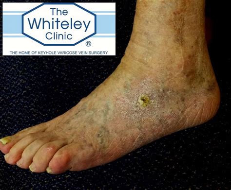 Venous Foot Ulcer Cured By The Whiteley Protocol®