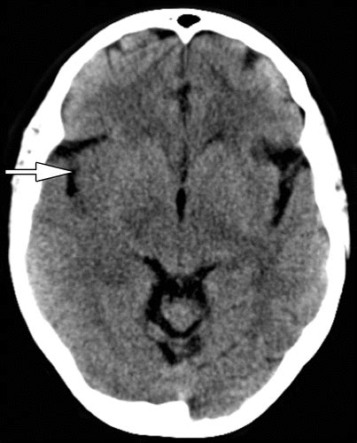 Ct For Treatment Selection In Acute Ischemic Stroke A Code Stroke