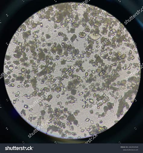 Uric Acid Crystals Urine Sediment Microscope Stock Photo 2263910549