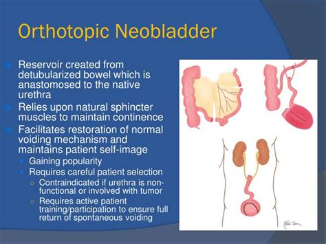 Ppt Multi Modality Imaging Of Urinary Diversion Complications