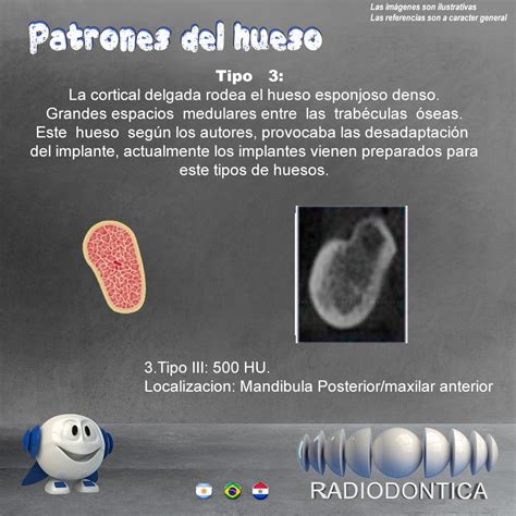 Caso Nº 21 Patrones Tipos de huesos Radiodontica ar