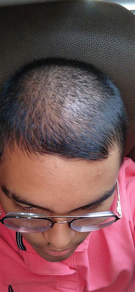 Balding At 16 Rmalehairadvice