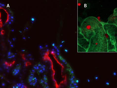 Role of Immune Cells in Early Diabetic Cataract Development | HAWK