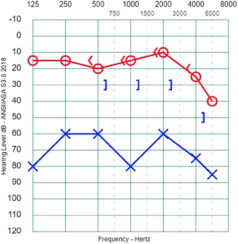 Audiogram Of The Patient Showing A Moderate Conductory Hearing Loss In