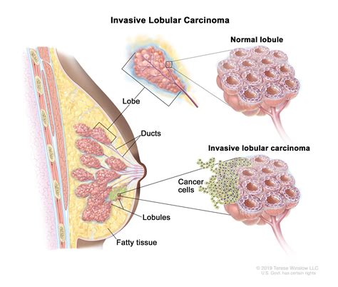 Invasive Lobular Carcinoma Invasive Lobular Carcinoma Mimicking
