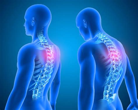 Como Melhorar A Lordose Com Exercícios Quais São As Opções Mais