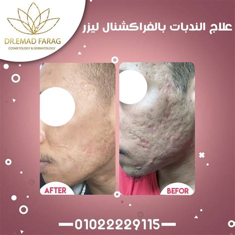 علاج الندبات بالفراكشنال ليزر الدكتور عماد فرج افضل استشاري في تجميل