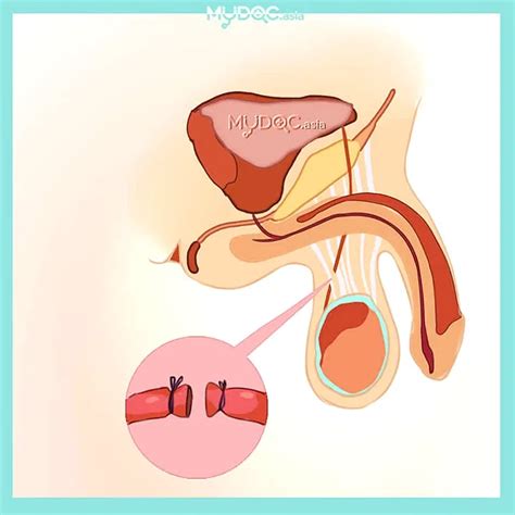 Apa Itu Vasektomi Simak Manfaat Dan Prosedurnya Di Sini Bisik Id
