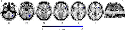 Frontiers Decreased Intrinsic Neural Timescales In Mesial Temporal