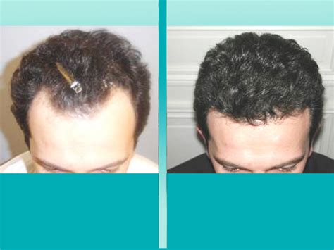 Before And After Hair Loss Treatment Neograft Injectable Solutions