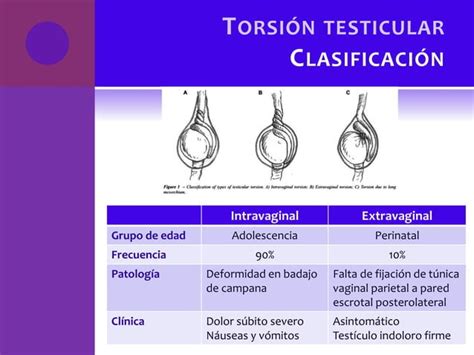 Torsion Testicular Ppt