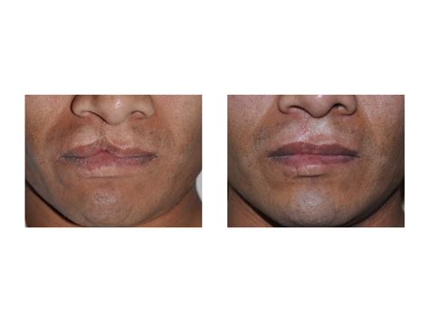 Case Study Adult Primary Cleft Lip Repair Explore Plastic Surgery