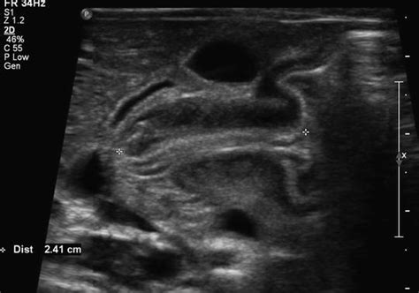 Infant With Nonbilious Emesis Basicmedical Key