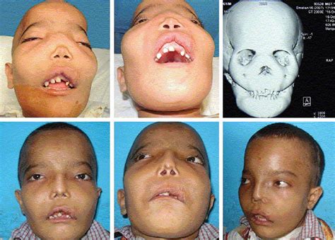 Fibrous Dysplasia Causes Symptoms Diagnosis Treatment And Life Expectancy