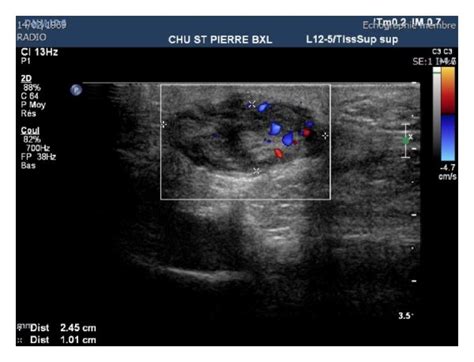 An ultrasound of the plantar arch was made and found a hypoechoic and ...