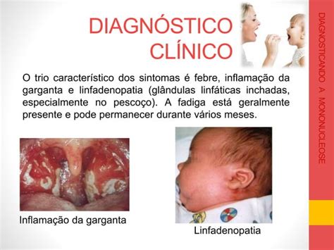 Mononucleose Infantil - Caso clínico de mononucleose – mononucleosis tratamiento – Akapv