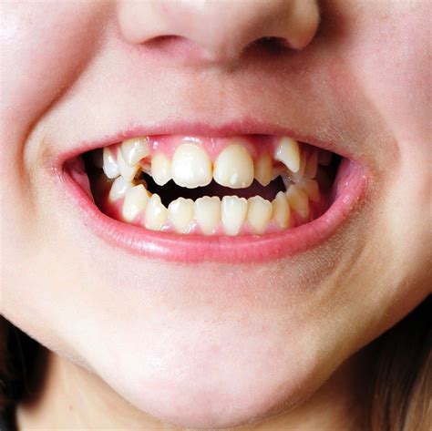 correct  incorrect position   teeth  orthodontist  barcelona