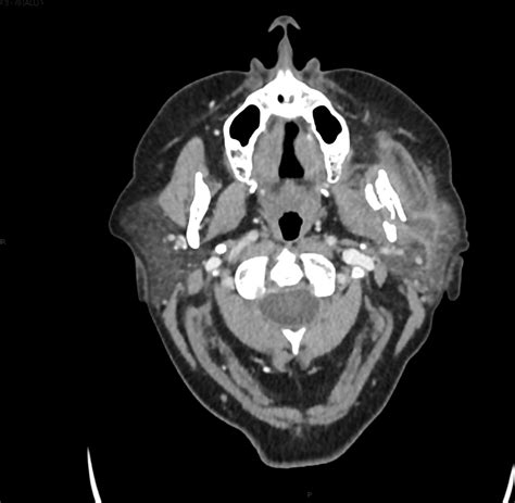 Acute On Chronic Parotitis Causing Osteomyelitis And Pathological