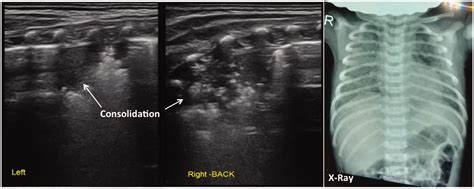 Meconium Aspiration Syndrome X Ray