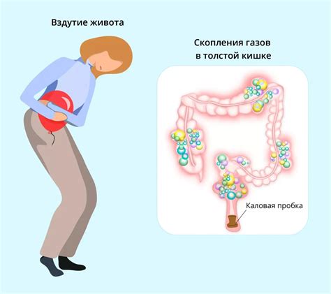 Метеоризм. Большая российская энциклопедия
