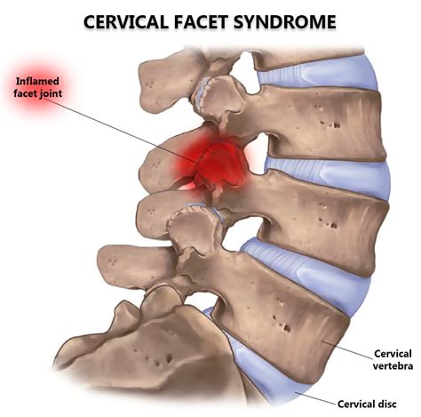Cervical Facet Syndrome Nj And Nyc Cervical Osteoarthritis Treatment In