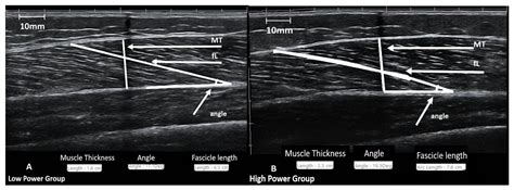 Weak Association Between Vastus Lateralis Muscle Fiber Composition And