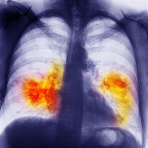 Copd Stages And Life Expectancy Chart
