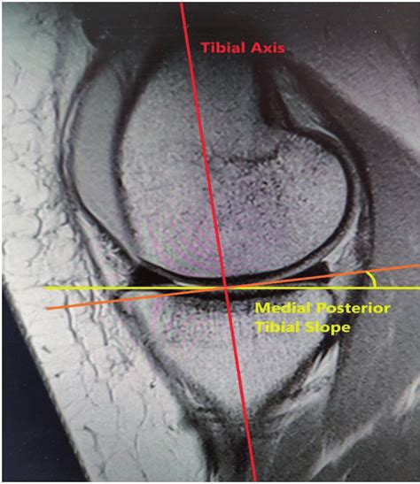 Mri Picture Depicting Calculation Of Medial Posterior Tibial Slope Mpts