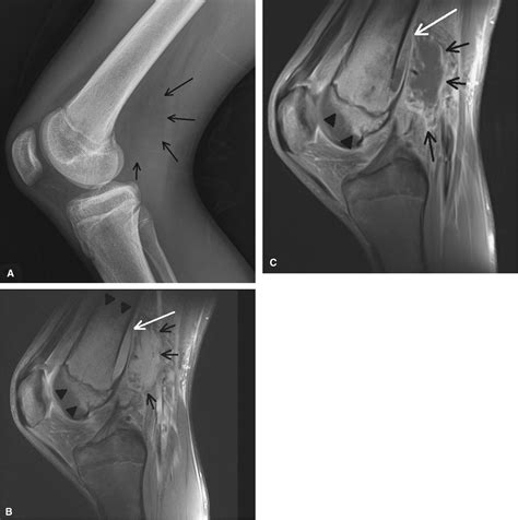 Imaging Of Knee Swelling In Children Contemporary Diagnostic Radiology