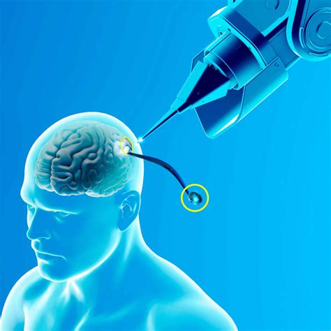 Neuralink La Premi Re Puce Implant E Dans Un Cerveau Humain