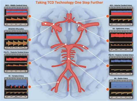 Transcranial Doppler Is A Standard Reimbursable Procedure