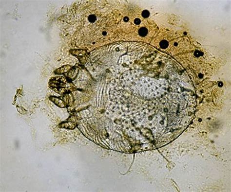 Scabies Mites In Carpet Carpet Vidalondon