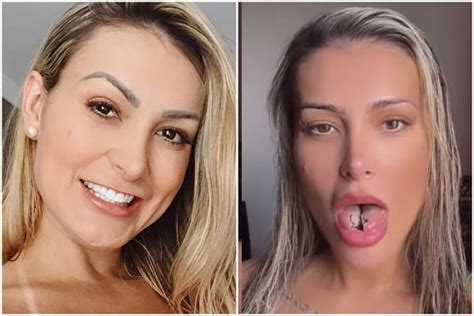 L Ngua De Cobra Entenda O Procedimento Feito Por Andressa Urach