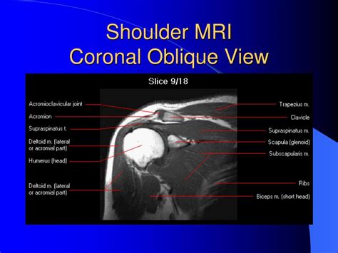 Coronal Shoulder Mri Setup At Neal Marquez Blog