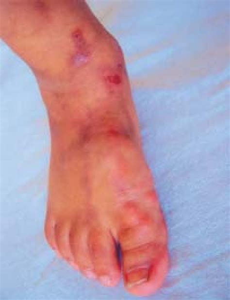 Figure From Calcinosis In Juvenile Dermatomyositis Semantic Scholar