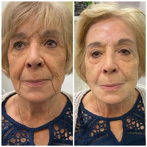 Lymphatic Drainage Facial Ultima Med Spa