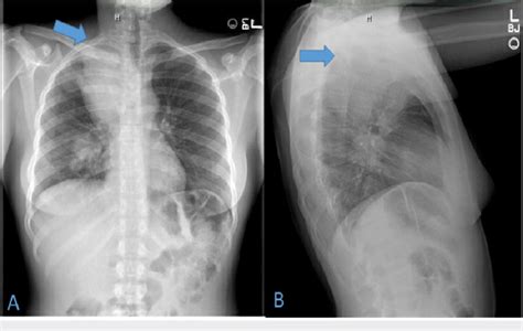 Postero Anterior And Lateral View Of Chest X Ray 1a Postero Anterior