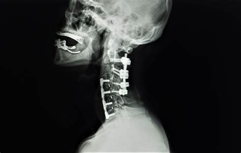 Anterior Cervical Discectomy and Fusion and Non-Surgical Options