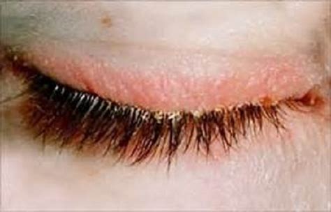 What Is Blepharitis Its Common Signs And Symptoms