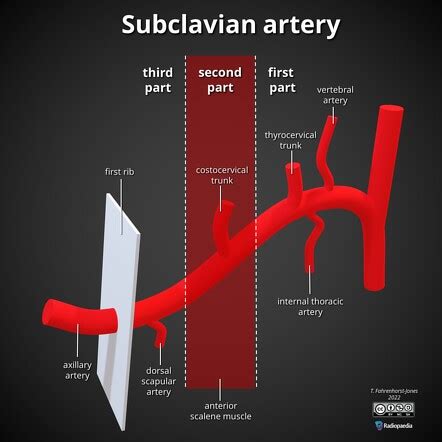 Subclavian artery branches (mnemonic) | Radiology Reference Article | Radiopaedia.org