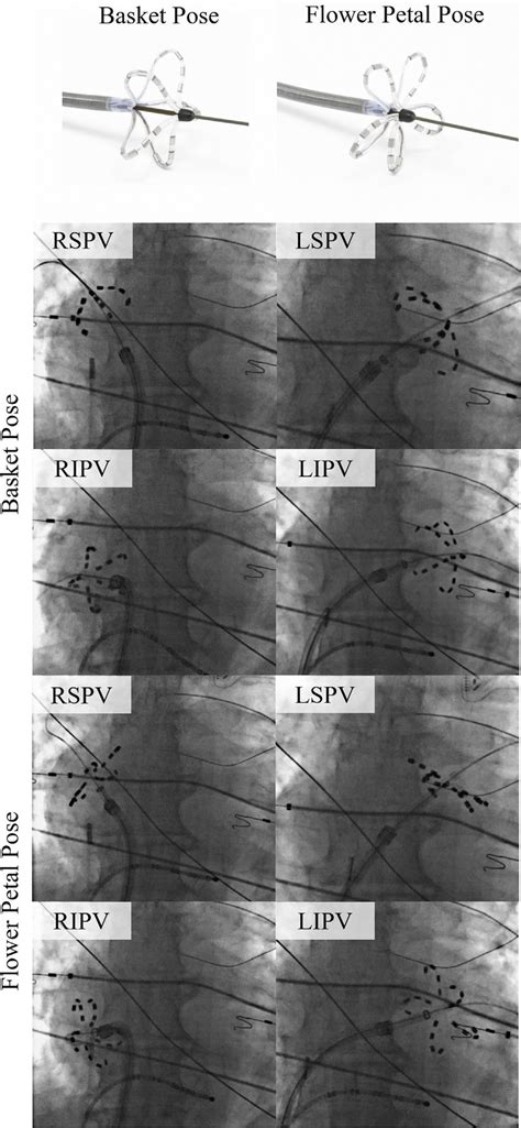 Fluoroscopic Imaging During Pulsed Field Ablation The Pulsed Field