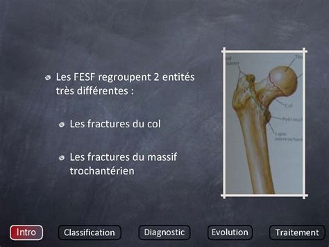 Fractures De Lextremite Superieure Du Femur Chez Ladulte