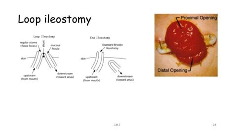 Stoma