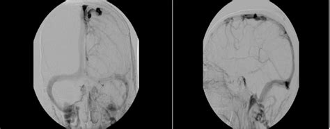 Venography - California Center for Neurointerventional Surgery