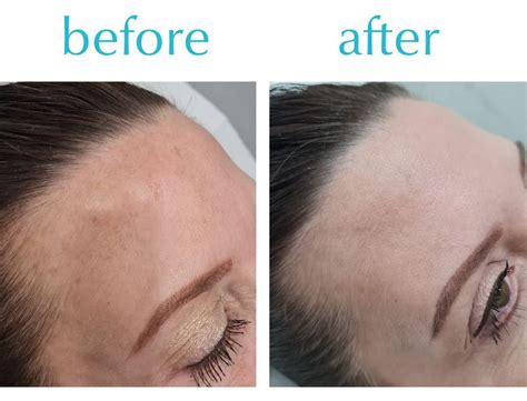 Melasma And Chemical Peels Acne Treatment Prfkt® Pro